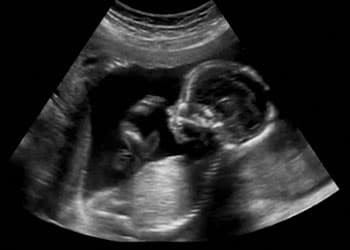 علاج إدمان الكريستال ميث والشبو .. 10 خطوات لتجنب الإنتكاس 5 الكريستال ميث والحمل